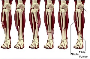 پاورپوینت کلیات شکستگی -43 اسلاید