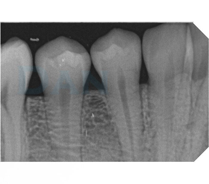Trident - I-View Digital X-Ray Sensor