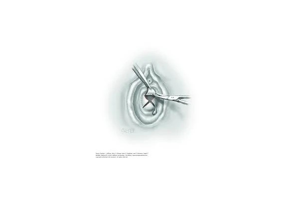 ویدئو هایمنکتومی