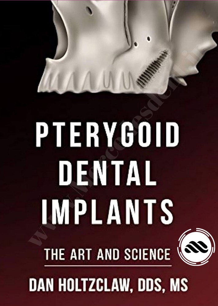 Pterygoid Dental Implants