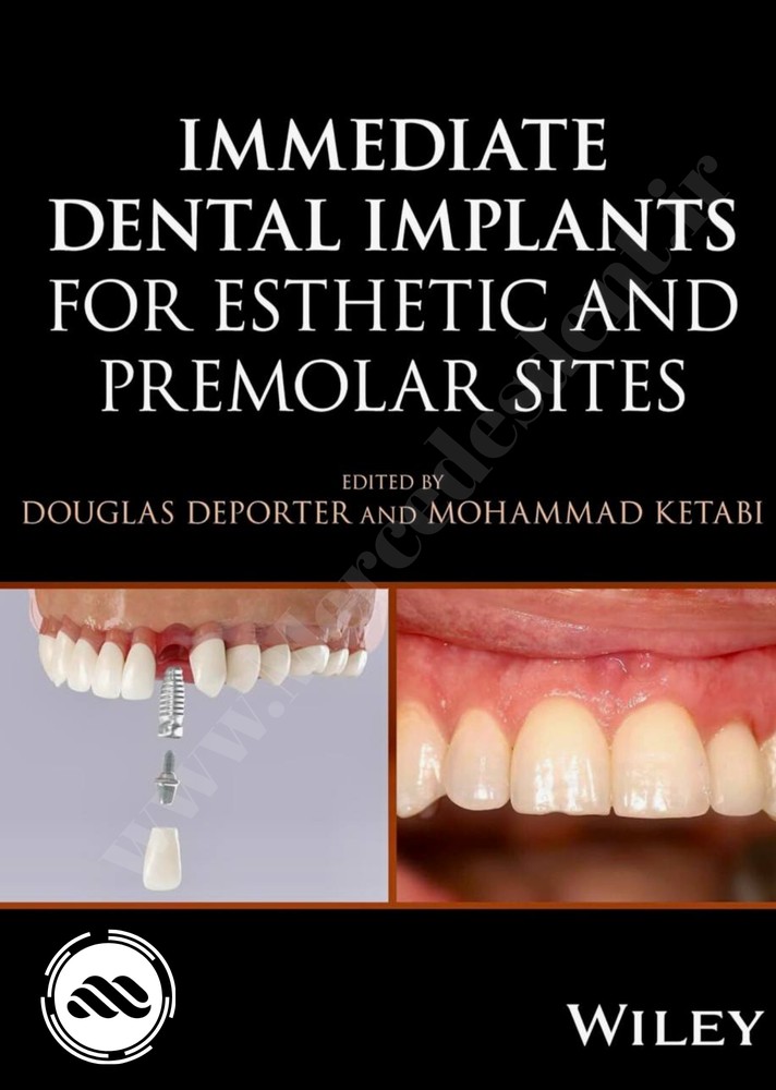 Immediate Dental Implants For Esthetic And Premolar Sites