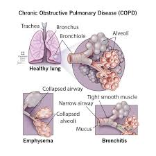 فایل صوتی مبحث COPD درس داخلی پزشکی - فایلمس