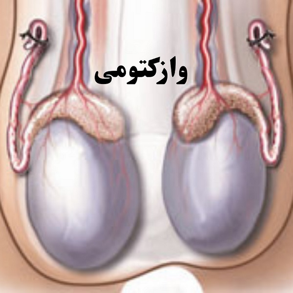 دانلود پاورپوینت کاندوم یا وازکتومی - فایلمس