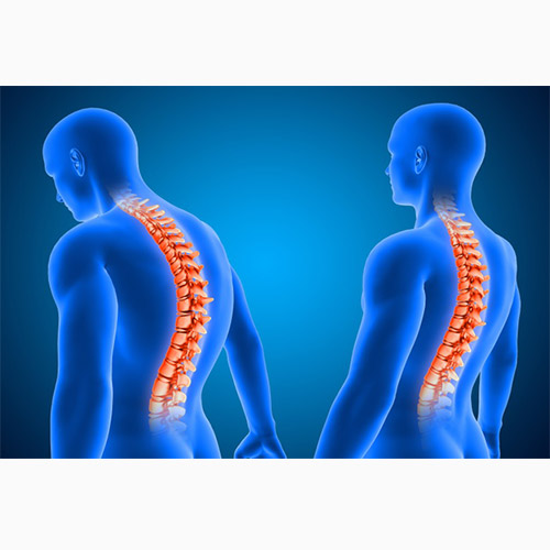 ناهنجاری کایفوزیس و حرکات اصلاحی آن