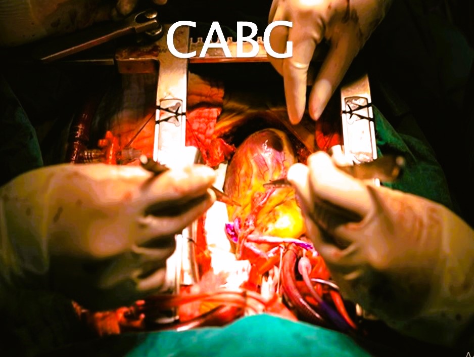 پاورپوینت پیوند عروق خونی (CABG) - پاورداک