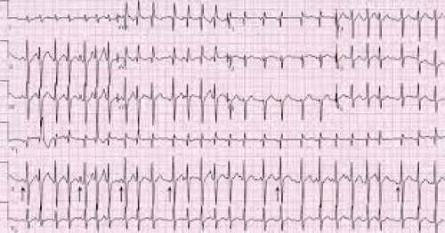 پاورپوینت آماده تدریس و ارائه تفسیر مقدماتی نوار قلب (Preliminary interpretation of ECG) - اسمارت فایل