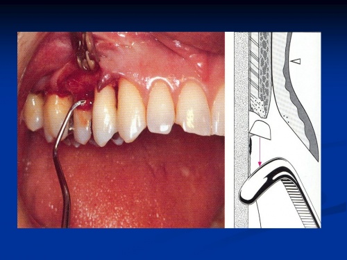 پاورپوینت آماده ارائه و تدریس فلپ های پریودنتال(Periodontal flaps) - اسمارت فایل