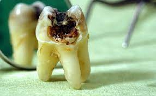 پاورپوینت تدریس و کنفرانس DENTAL CARIES (پوسیدگی دندان) - اسمارت فایل