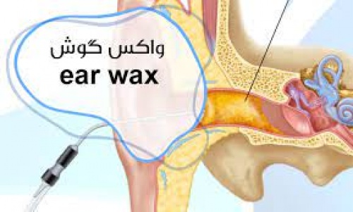 واکس گوش(Ear Wax) - اسمارت فایل