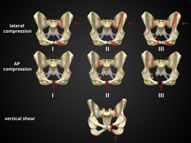پاورپوینت شکستگی لگن PELVIC FRACTURE - پاورداک