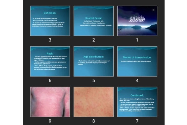 پاورپوینت Scarlet Fever
