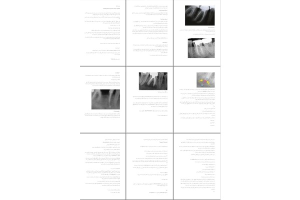 جزوه پركردن كانال OBTURATION of the ROOT CANAL SYSTEM