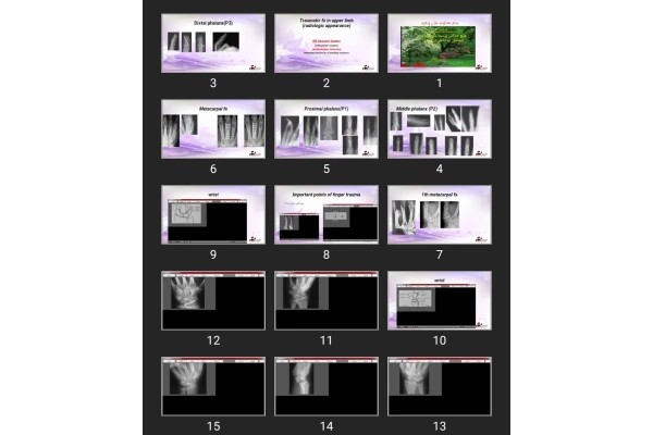 پاورپوینت Traumatic fx in upper limb (radiologic appearance)