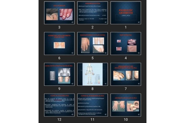 پاورپوینت Psoriatic Arthritis