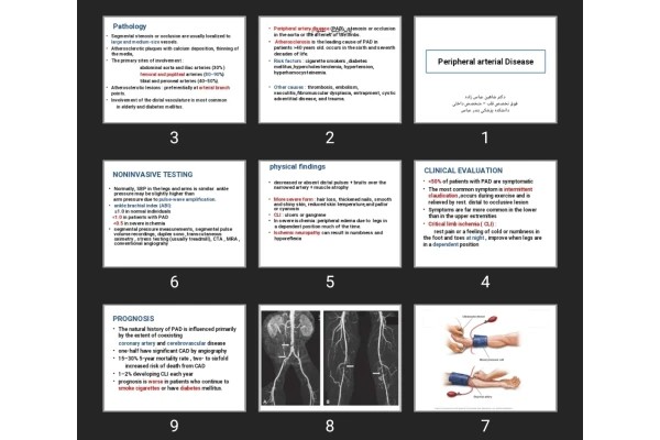 پاورپوینت Peripheral arterial Disease