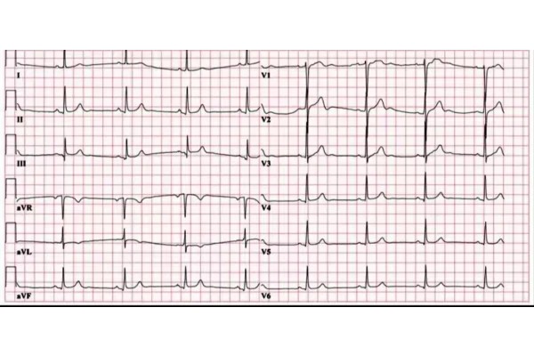 جزوه آموزش نوار قلب (ECG)برای پرستاران