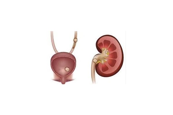 پاورپوینت سنگ کلیه