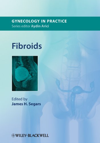 فیبروم ها ۲۰۱۳ <br> Fibroids 2013 - کالیبو