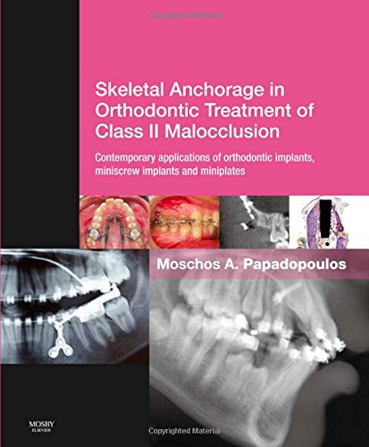 لنگرگاه اسکلتی در درمان ارتودنسی ناهنجاری کلاس ۲: کاربردهای نوین ایمپلنت های ارتودنسی، مینی اسکروایمپلنت ها و مینی پلیت ها ۲۰۱۴ <br> Skeletal Anchorage in Orthodontic Treatment of Class II Malocclusion: Contemporary Applications of Orthodontic Implants, Miniscrew Implants and Mini Plates 2014 - کالیبو