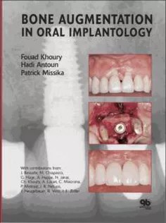 دانلود کتاب Bone Augmentation in Oral Implantology
