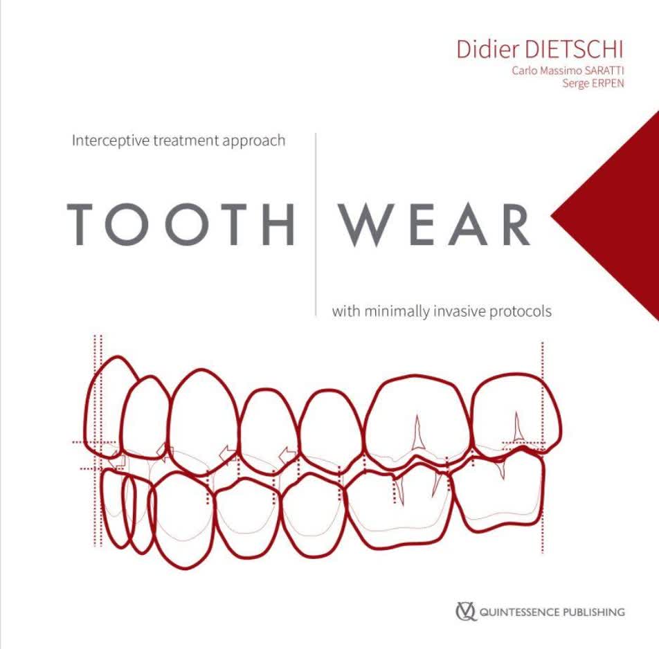 کتاب Tooth Wear
