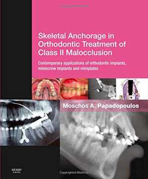 دانلود کتاب Skeletal Anchorage In Orthodontic Treatment Of Class II Malocclusion – Contemporary Applications Implants, Miniscrew Implantsand Mini Plates, 1E, 2015