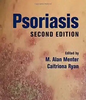 دانلود کتاب Psoriasis, Second Edition